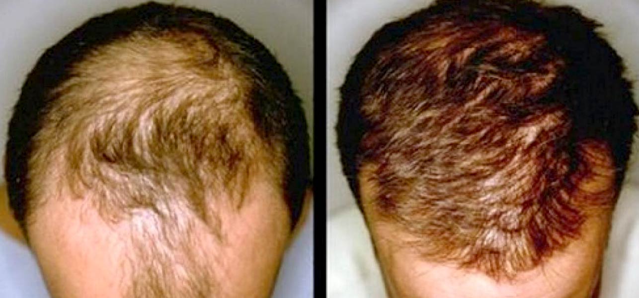 regrow hair with lemon juice